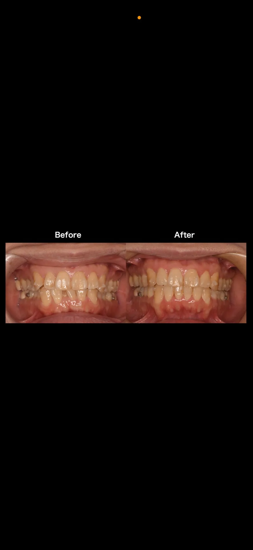 マウスピース矯正